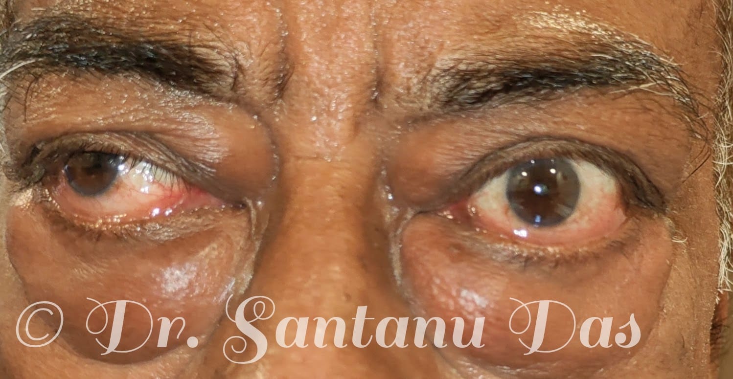 Thyroid Eye Disease View 1
